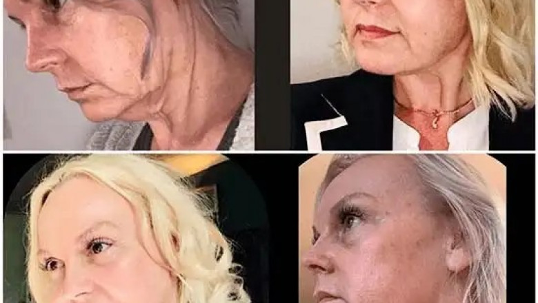 Amplify Beauty at the Best Aesthetic Clinics in dubai through Profhilo