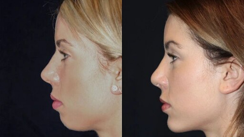 Best Aesthetic Clinics in dubai for Chin Fillers Enhancements