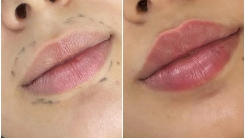 Best Aesthetic Clinics in dubai for Juvederm Full Face Rejuvenation