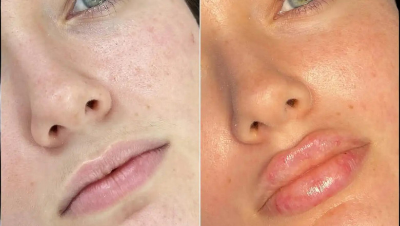 Transform Your Look with Best Aesthetic Clinics in dubai for Fillers