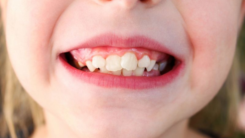 What Age Is Best to Treat Crowded Teeth?