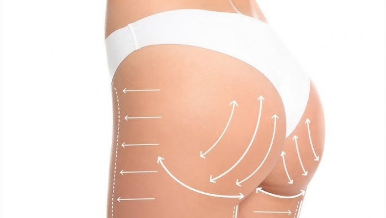 Butt Fat Transfer in Dubai: What the Best Doctors in Dubai Want You to Know