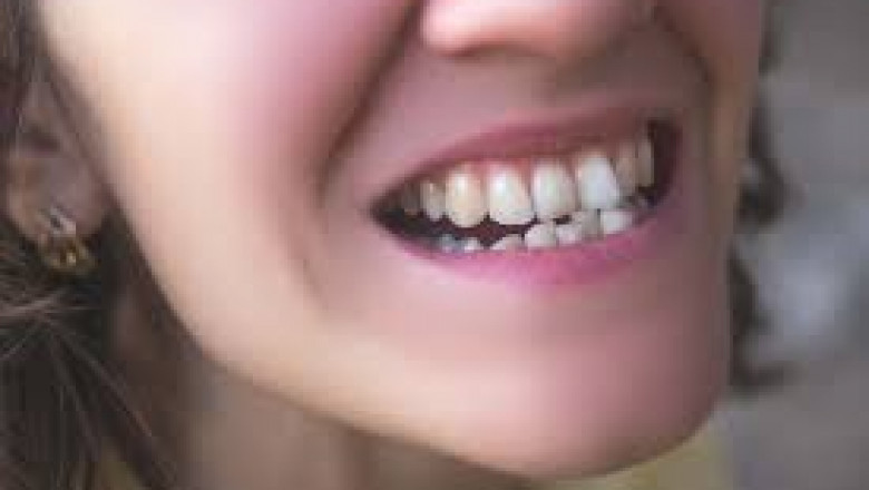 Are Overlapping Teeth a Cosmetic or Medical Issue?
