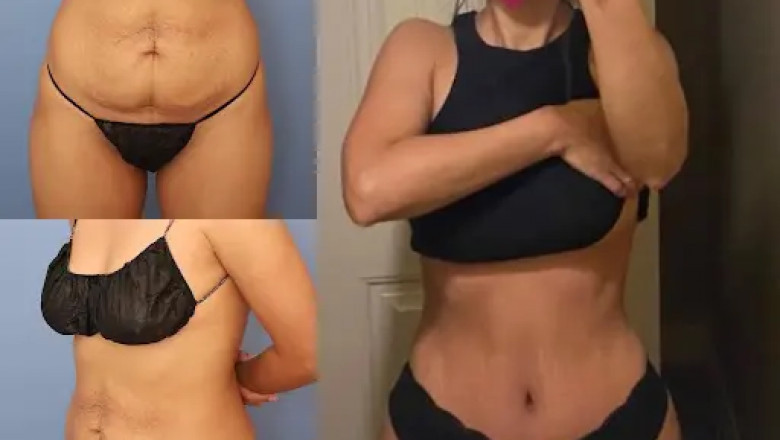 Why Tummy Tuck in Dubai Is Becoming So Popular Among International Patients