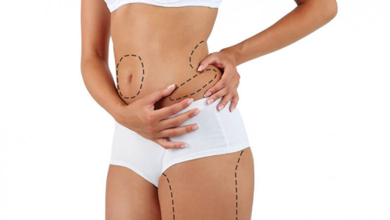 How Much Does Liposuction Cost in Islamabad?