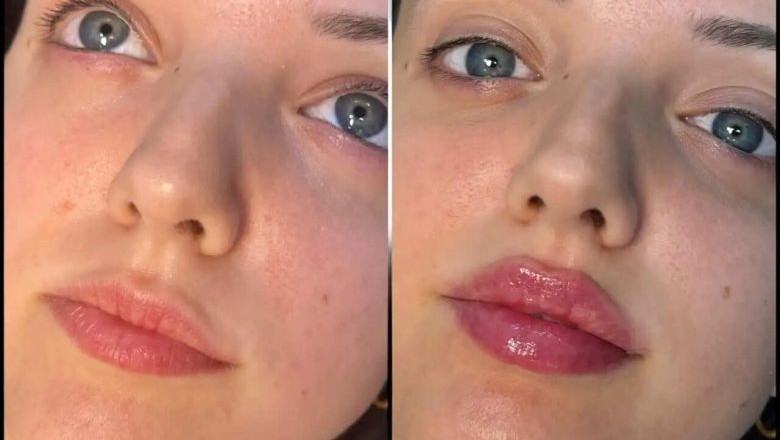 How to Achieve Youthful Skin with the Best Plastic Surgeons in Dubai for Fillers
