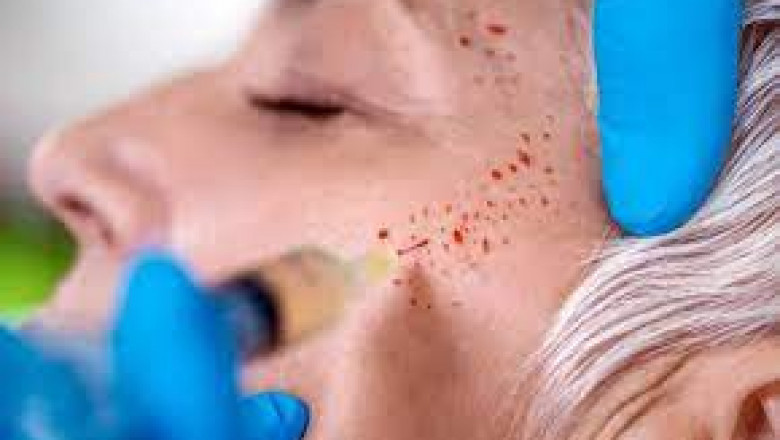How Does a Vampire Facial Compare to Botox or Fillers?