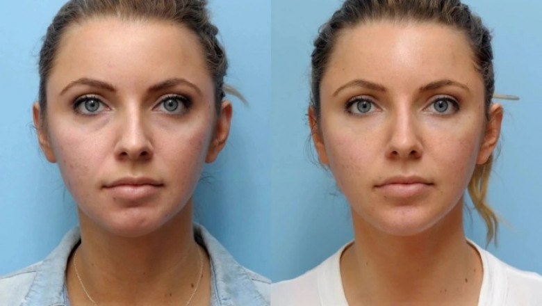 Recovery and Aftercare Tips from the Best Plastic Surgeon in Dubai After a Thread Lift