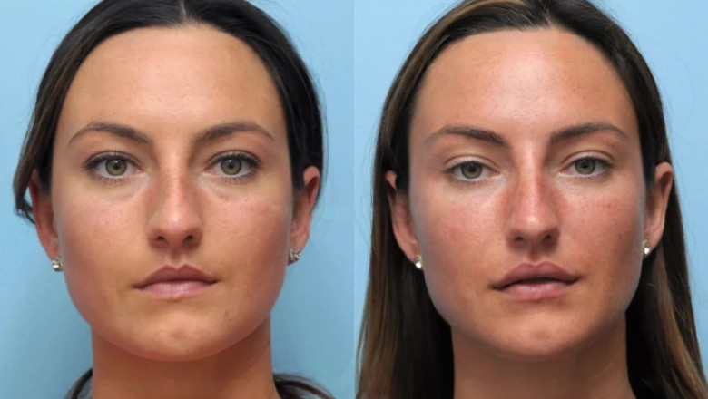 The Most Sought-After Look by the Best Plastic Surgeon in Dubai for Thread Lift
