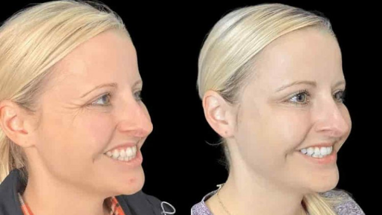 Wrinkle-Free Results from the Best Plastic Surgeon in Dubai for Botox
