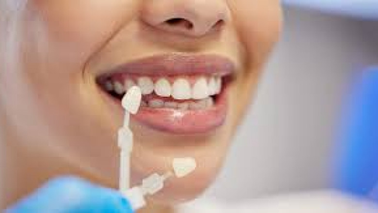 Are Composite Veneers Permanent or Temporary?
