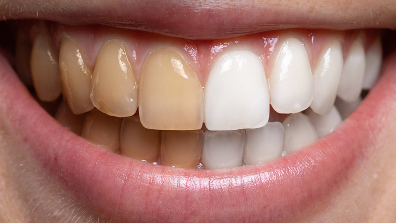 How to Tell If You Need Professional Teeth Whitening?