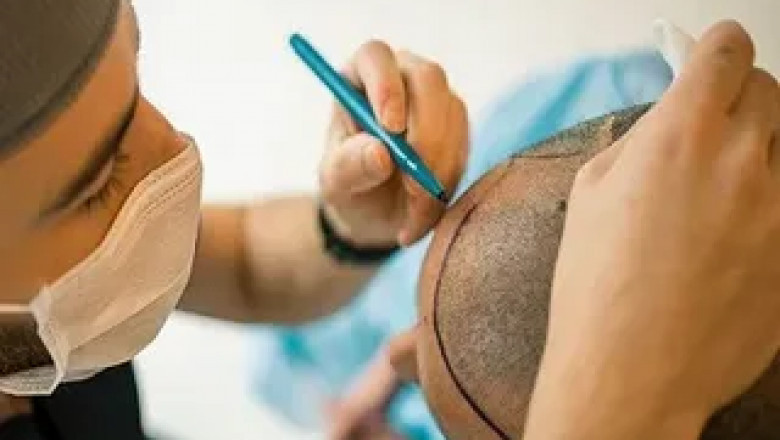 Islamabad's Hair Transplant Clinics Offering Virtual Consultations