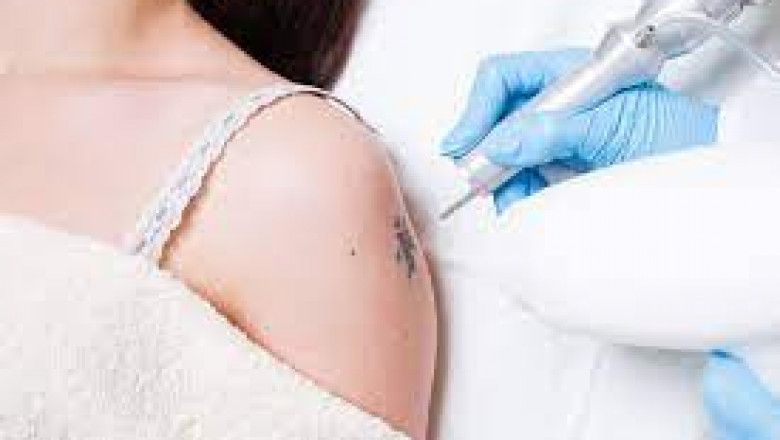 What Are the Best Aftercare Tips for Laser Tattoo Removal?