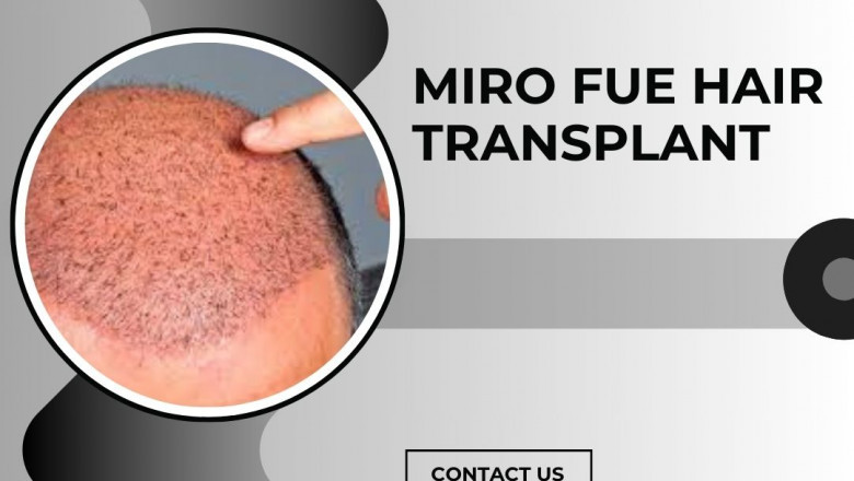 Best FUE Hair Transplant in Bangalore | FUE Hair Transplant Cost