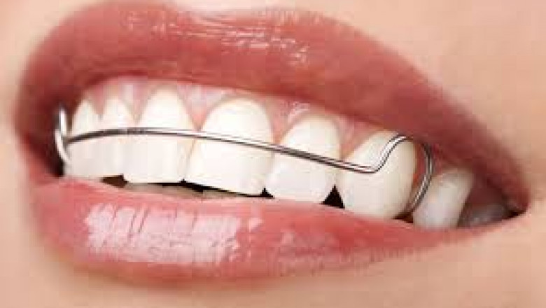 Can Dental Retainers Prevent Teeth from Moving During Wisdom Teeth Growth?