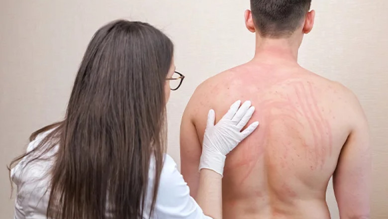 Can You Sue for Stevens-Johnson Syndrome?