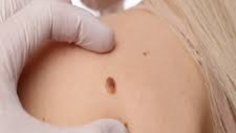 How to Prevent Birthmarks from Returning After Removal?