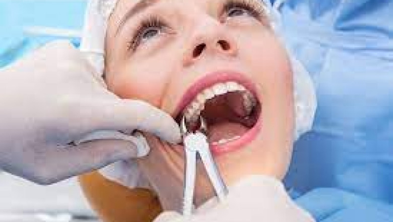 What Are the Most Common Reasons for Tooth Removal?