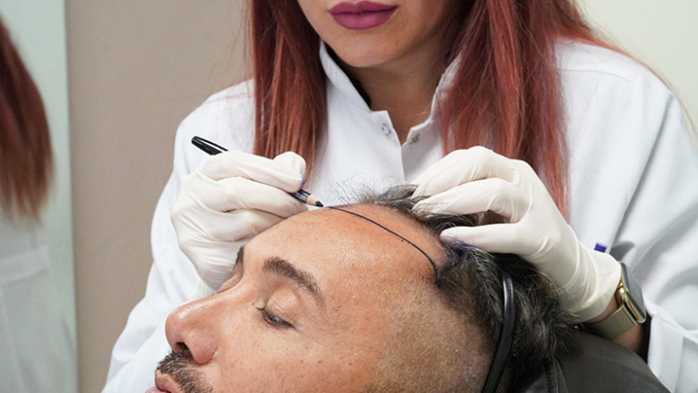 How Many Hair Transplant Sessions Do You Need for Best Results