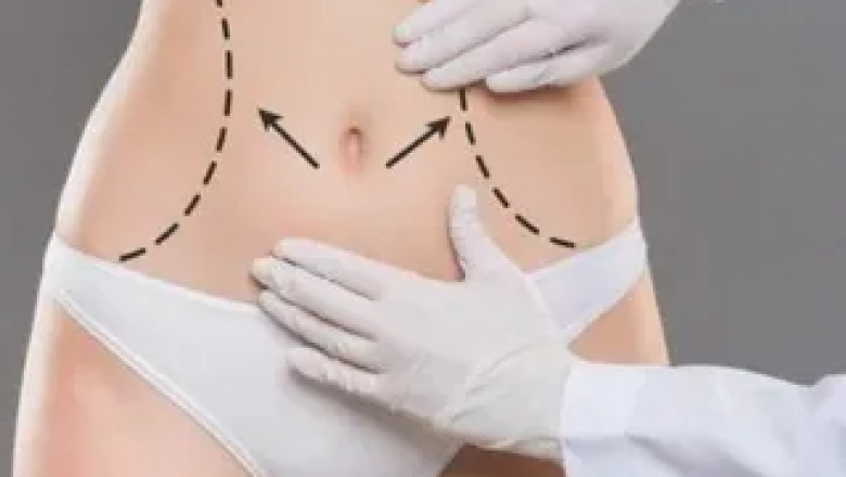 How to Choose Between Tummy Tuck and CoolSculpting in Islamabad