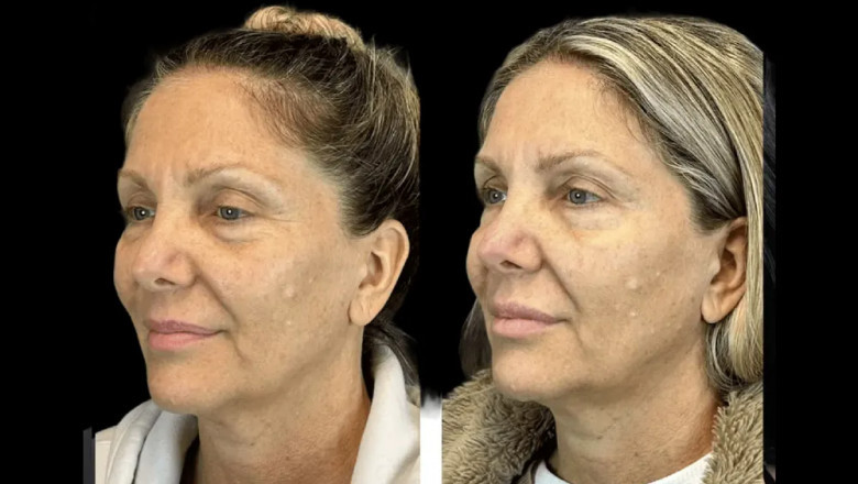 Latest Botox Innovations by the Best Doctors in dubai