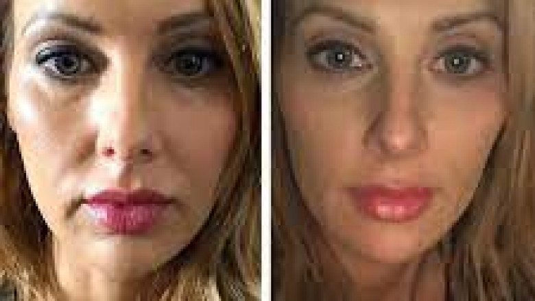 Choosing the Best Doctors in Dubai for Your Thread Lift Journey