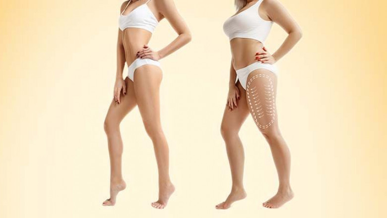 Transform Your Body with Expert Liposuction in Dubai by Dr. Hans