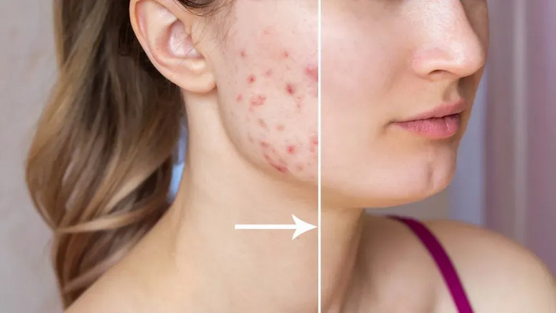 Can You Wear Makeup After a Chemical Peeling