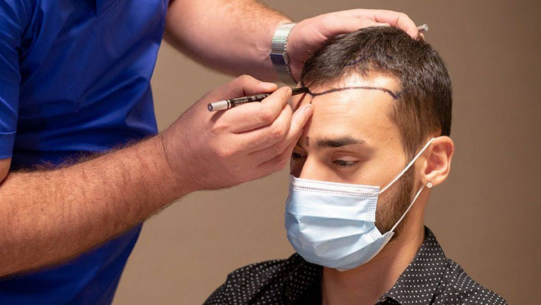 Do Hair Transplants Leave Scars in Islamabad?
