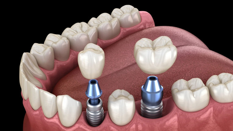 Why Dental Implants Are Worth the Investment?