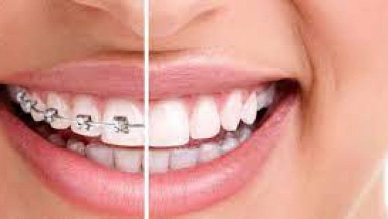 How to Manage Discomfort with Braces?