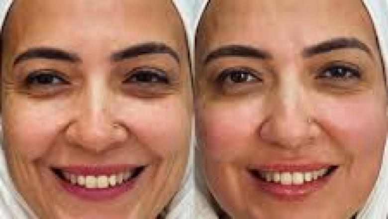 Revitalize Skin Naturally Using Bio Stimulator in Jeddah
