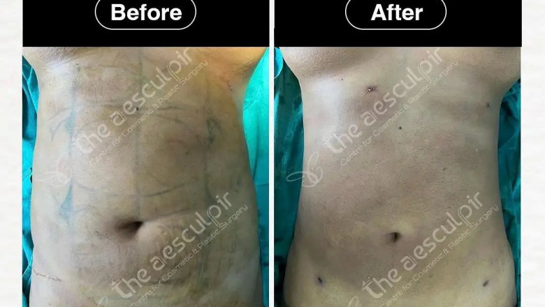 Discover Affordable Liposuction Surgery Cost in India with the Best Plastic Surgeon at Theaesculpir
