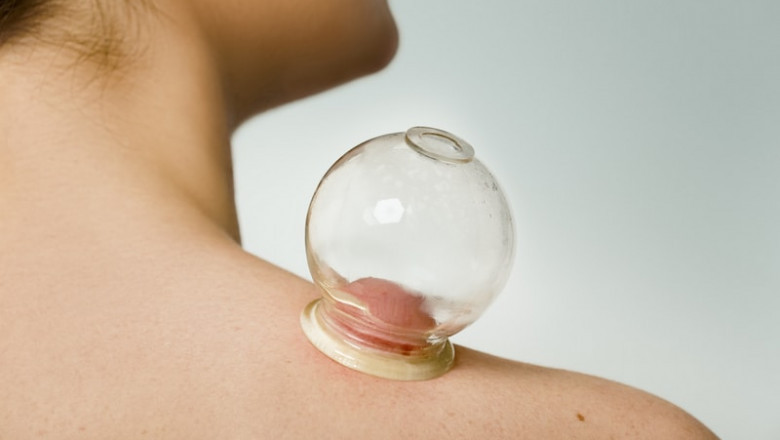 Hijama for Office Workers: Combating Sedentary Lifestyle Illnesses