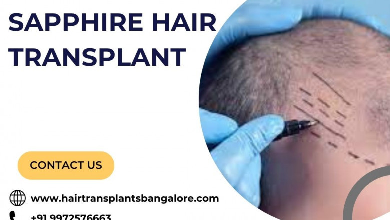 Sapphire Hair Transplant in Bangalore | Hair Transplant