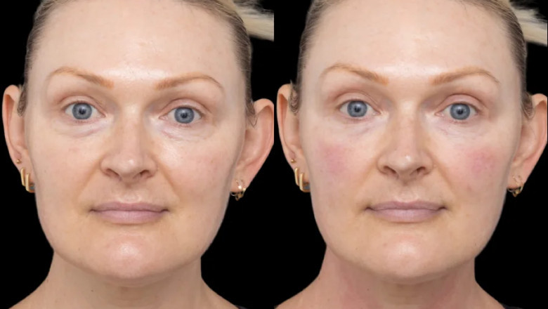 The Ideal Age to Start Under Eye Fillers Treatment in Dubai