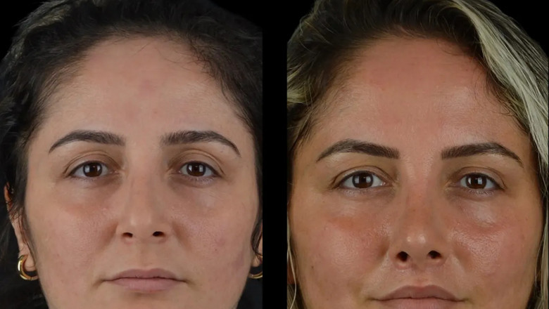 The Most Popular Cheek Fillers Treatment in Dubai