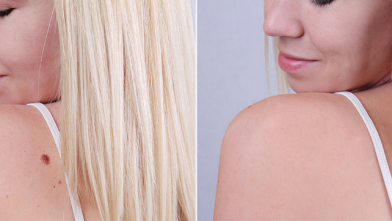 Best Dermatologists for Warts Removal in G-8 Islamabad