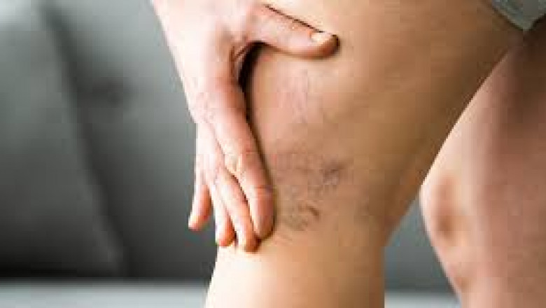 How to Choose the Right Clinic for Varicose Vein Treatment?