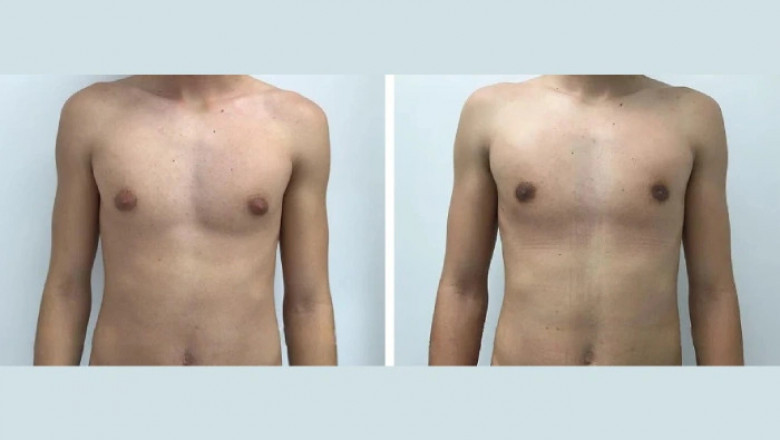 10 Qualities of the Best Gynecomastia Surgeon in dubai