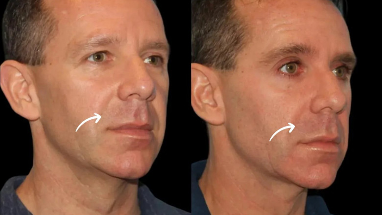 Are You a Candidate? Screening by the Best Doctors in Dubai for Sculptra Fillers