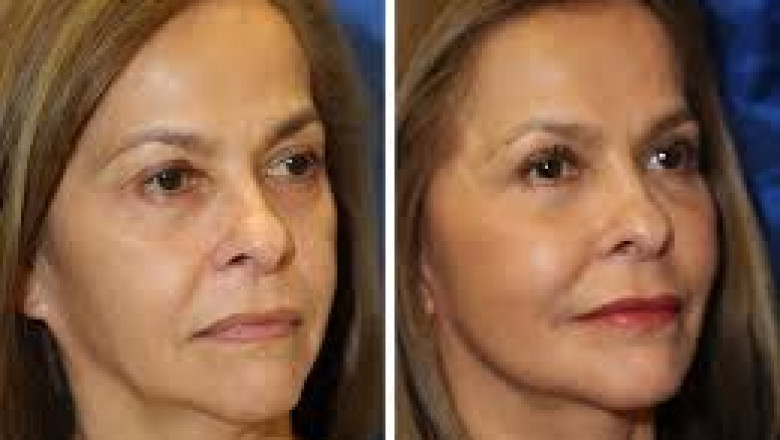 Facial Fat Injections Market Estimated to Grow with Nanofat Enrichment Technology