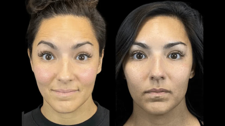 How Often Should You Get Botox? Insights from the Best Doctors in dubai