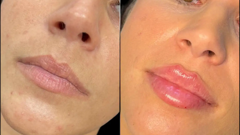 Get That Glow at the Best Aesthetic Clinics in Dubai for Fillers