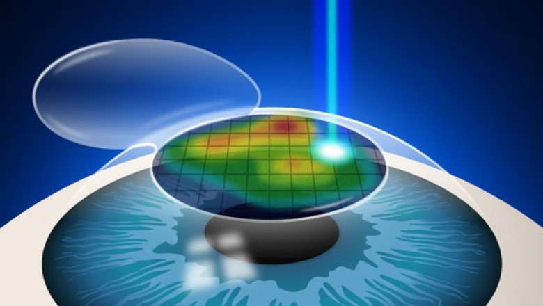 Still Confused In Laser Eye Surgery In Delhi NCR?
