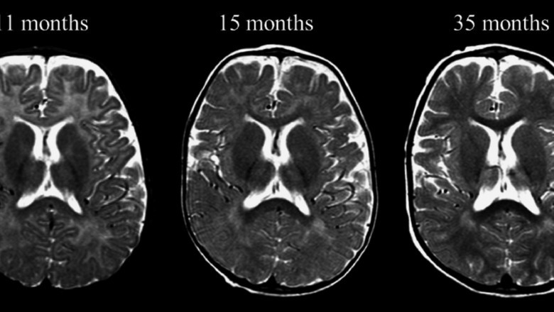 Menkes Disease Market to Grow Rapidly Owing to Advancements in Gene Therapy