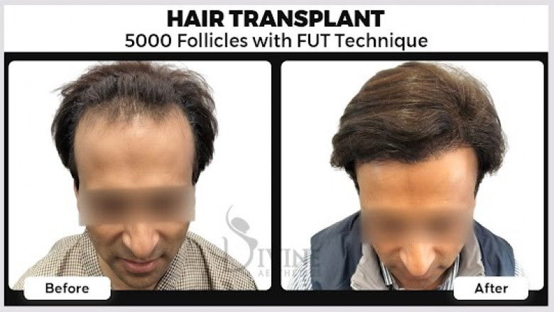 The Complete Guide to Hair Transplant in Gurgaon and Noida by Dr. Amit Gupta