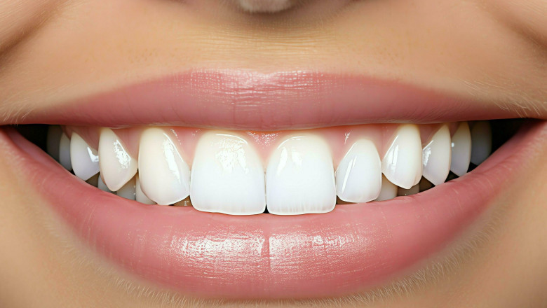 Are Nano Teeth Whitening Results Permanent?