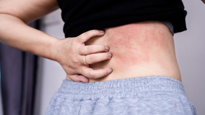 Chronic Spontaneous Urticaria Market to Grow Fast on Biologic Adoption